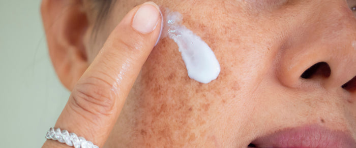 5 Steps to Treating Your Pigmentation