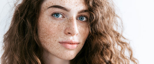 What are freckles?